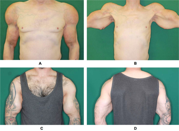 Key Differences in Synthol vs Steroids Comparison Explained